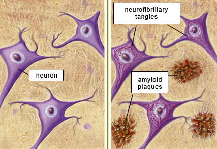 Normale en Alzheimer hersenen